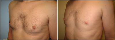 gynecomastia-surgeon-long-island-before-after-8-2